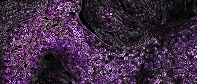 NEJM里程碑：KRAS G12C获得性耐药突变图谱出炉，揭示KRAS抑制剂开发新挑战