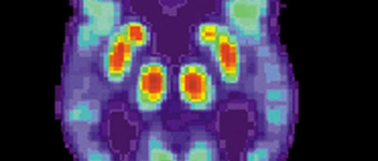 【PNAS】火起来的“相分离”又有新发现！或揭示阿尔茨海默氏病病因