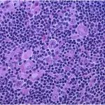 2期临床试验表明CAR-T细胞疗法axi-cel有效治疗高危大B细胞淋巴瘤