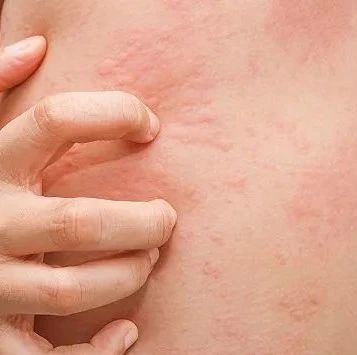 诺华新一代IgE抗体ligelizumab获美国FDA突破性药物资格!