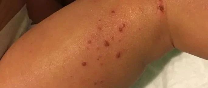 Science重磅：人类皮肤细胞图谱揭示出湿疹和牛皮癣的病因