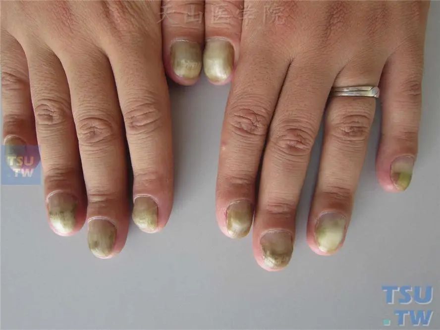 指甲变形竟然是癌,关于指甲的这些暗示你知道吗?