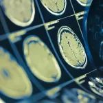 还敢看电视吗？研究发现：每多看1小时电视，大脑灰质体积减少0.5%...