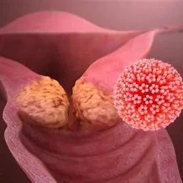 ESMO 2020：抗体-药物偶联物Tisotumab vedotin治疗复发宫颈癌取得积极进展