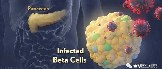 |必读|最新研究证实新冠病毒感染后诱发糖尿病激增