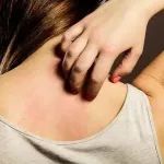 治疗特应性皮炎，康乃德生物IL-4Rα靶向药中国关键临床达主要终点！