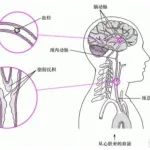 心玮医疗IPO：布局取栓器械完整产品套装扬帆神经介入蓝海市场