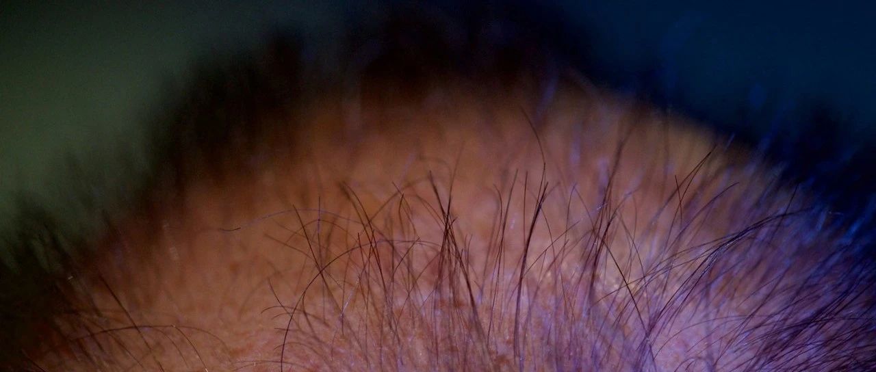 脱发治疗新希望！程柯教授团队Science子刊发文：发现可促进头发再生的miRNA疗法