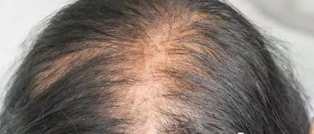 “秃头”的福音！中国科学家团队开发出治疗“雄脱”的新方法