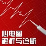 1 例预激综合征合并房颤的心电图表现
