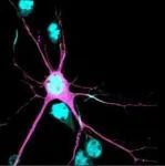 一种新的儿童神经发育综合征被科学家发现