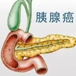 DNA甲基化在胰腺癌早期诊断及治疗中的研究进展