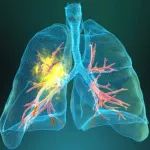 【最新发现】SOX1基因高甲基化与肺癌患者预后相关