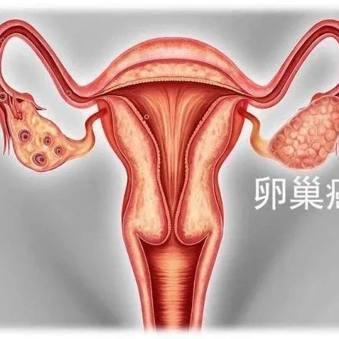 卵巢癌重磅！欧盟CHMP推荐批准Zejula(则乐)一线维持治疗，不论生物标志物如何，已在中国上市！