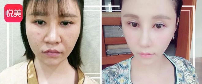 【精品】关于鼻整形的所有疑问，看这篇就对了！
