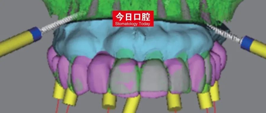 提高即刻种植即刻修复精度的新技术——序列导板辅助重度牙周炎患者全牙列种植 | 杨静文博士、王勇教授