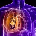 2021AACR口头报告丨信迪利单抗全程守护晚期鳞癌患者——唯一针对中国人群肺鳞癌二线治疗Ⅲ期临床研究ORIENT-3达主要终点