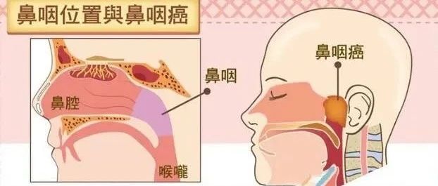又一知名导演因鼻咽癌逝世！为什么它被称为“广东癌”？