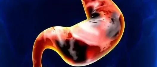 胃肠道间质瘤靶向新药获批 直击耐药之“痛”