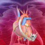 国产首款全磁悬浮式人工心脏正式上市