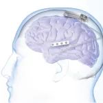 IPO早知道 | NeuroPace: 实时记录、治疗癫痫的植入型神经设备公司申请7500万美元IPO上市